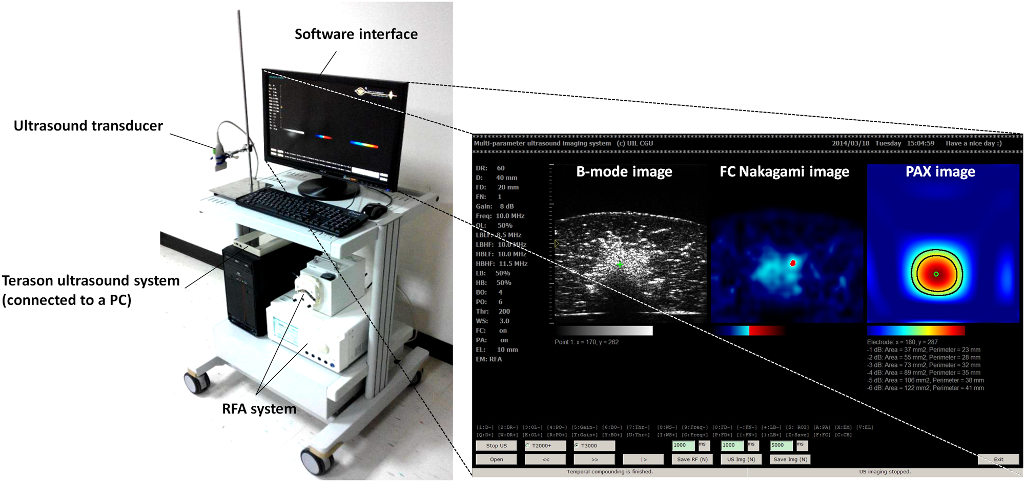 Monitoring Radiofrequency Ablation Using Real Time Ultrasound Nakagami Imaging Combined With Frequency And Temporal Compounding Techniques