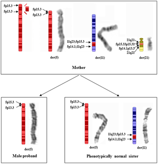 A Familial Cri Du Chat 5p Deletion Syndrome Resulted From Rare Maternal Complex Chromosomal Rearrangements Ccrs And Or Possible Chromosome 5p Chromothripsis