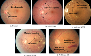 Predicting of diabetic retinopathy development stages of fundus images using deep learning based on combined features