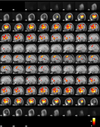 <h2>fMRI BOLD activity for the ON-OFF contrast.</h2>