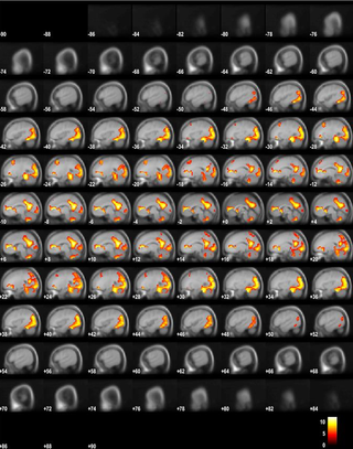 <h2>fMRI BOLD activity for the OFF-ON contrast.</h2>