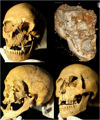 <h2>YNH4 Skull preservation.</h2>