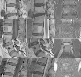 <h2>(1.) Examples for osseous lesions in MRI weighting of the vertrebra: 68Y old female with a hemangioma in a lumbar spine vertebrae 4.</h2>