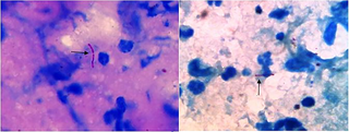 <h2>The presence of Acid-fast bacilli (Ziehl-Neelsen staining) in direct smears in lesion scrapping of patients infected by <i>Mycobacterium marinum</i>, ×100 objective.</h2>
