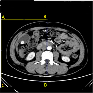 <h2>The CT image with ROI.</h2>