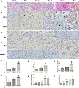<h2>Histopathological features and the expression of CD68, MR, and TREM-1 in the kidneys of diabetic nephropathy patients.</h2>