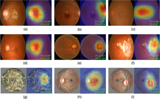 <h2>Visualization of the deep learning model on fundus images with different eye conditions.</h2>