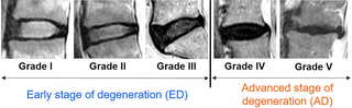 <h2>Magnetic resonance imaging (MRI) of human intervertebral disc classified according to the Pfirrmann grading system[<em class="ref">22</em>].</h2>