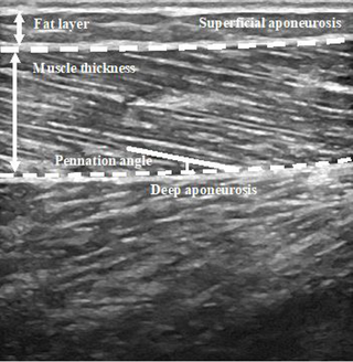 <h2>Example of fascicle tracking on an ultrasound image.</h2>
