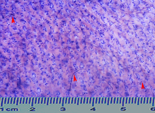 <h2>Sihler's staining revealed the distribution of intradermal nerves in the middle 1/3 area of the lateral posterior region of the right forearm.</h2>