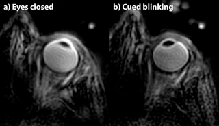 <h2>Sensitivity of magnetization-prepared ZTE imaging to eye motion.</h2>
