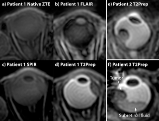 <h2>Magnetization-prepared ZTE imaging of the eye of three uveal melanoma patients.</h2>