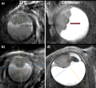 <h2>Tumor thickness measurements performed on the ZTE and Cartesian images of UM-patient 7.</h2>