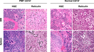BM and spleen fibrosis is readily detected in NSG mice transplanted with PMF, but not normal, CD14<sup>+</sup>/CD34<sup>-</sup> BM cells.
