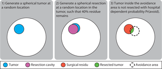 Schematic illustration of the generative model for brain tumor resections.