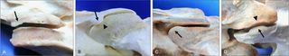 Progression of ventrally- or dorsally-deviated lateral joint margins (lateral views).