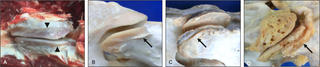 Progression in joint capsule enthesophytes (lateral views).