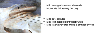 Combined osseous changes affecting the articular processes (dorsolateral view).
