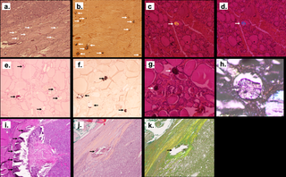 Illustration of the different patterns of crystals deposits in thyroid tissue using optic microscopy.