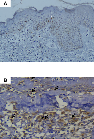BCL2 expression in normal and MF cases.