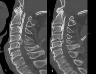 66-year-old man with neck pain and mobility disturbance after trauma.