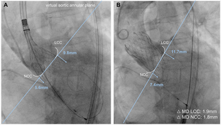 Exemplary illustration of micro-dislodgement during transcatheter aortic valve implantation.