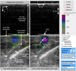Graphical user interface of the C++ application used for <i>in vivo</i> US thermal ablation imaging and control.