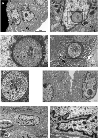 Ultrastructural analysis of intranuclear inclusions in papillary thyroid carcinomas with transmissionelectron microscopy (TEM).