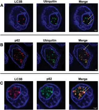 Double-IF studies of autophagy-associated proteins in PTC sections.
