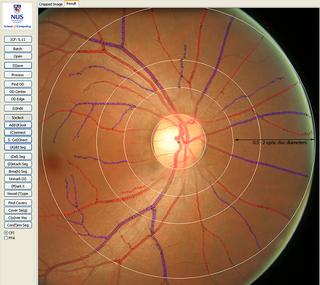 Retinal fundus image quantitatively assessed using the Singapore I Vessel Analyzer (SIVA) software.
