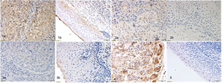 Pepsin staining in primary HPSCC tumors and matched adjacent tissues.