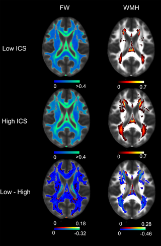 Association of ICS with overt and antecedent white matter injury.