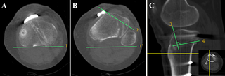 Measurement of the angle of vertical osteotomy direction and biplane osteotomy angle on computed tomography.