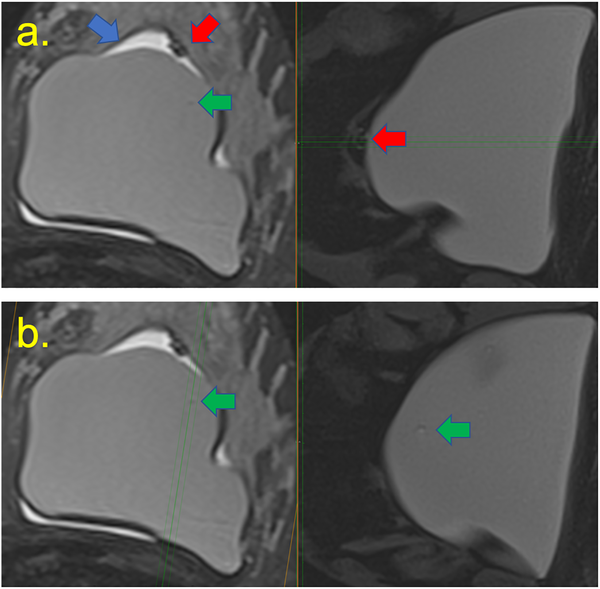 Silicone gel-filled implants. T2-weighted (a), silicone-only (b