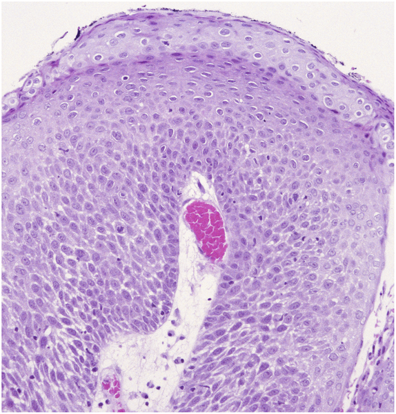 squamous papilloma with atypia